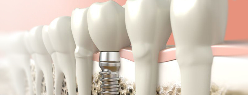 Sofortimplantation - CE Dental